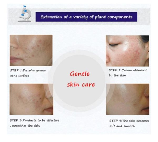 BioAqua Anti Acne & Scar Removal Cream – 30g (Original)