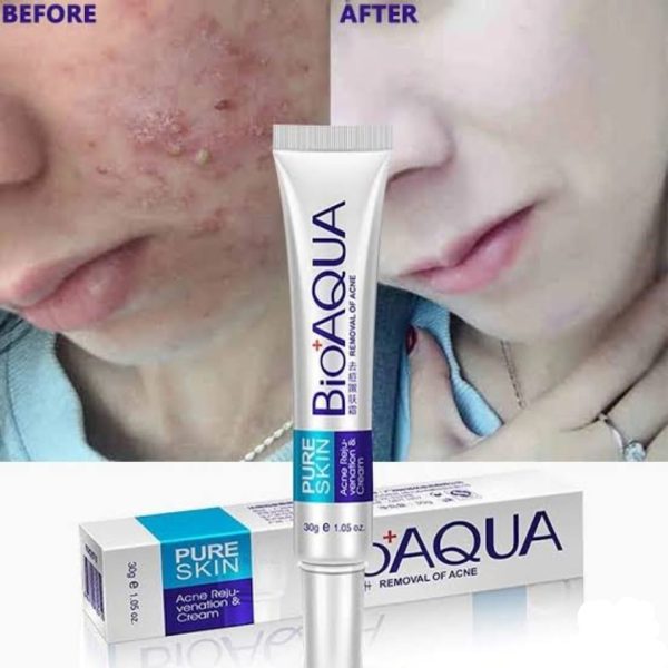 BioAqua Anti Acne & Scar Removal Cream – 30g (Original)